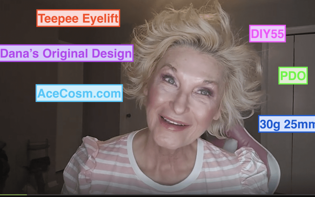 Teepee Eye Lift with PDO Threads